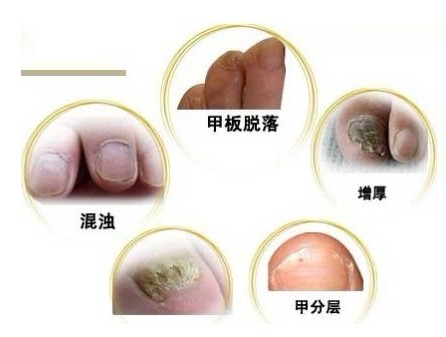 哪些症状说明你患上了灰指甲呢?