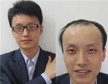 年纪轻轻就脱发