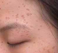 扁平疣的治疗方法有哪些
