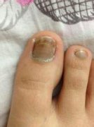 灰指甲的症状