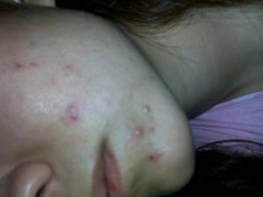 青春痘的表现