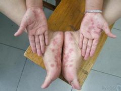 手足癣的症状