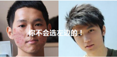 长春治疗青春痘的前后