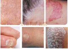 长春皮肤病医院介绍牛皮癣的症状