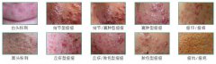 青春痘的症状
