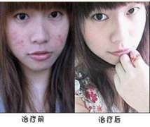 长处皮肤病医院介绍青春痘