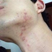 长春皮肤病医院介绍青春痘