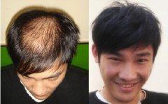 长春医院介绍脱发