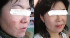 长春医院青春痘