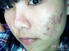 毛囊炎治疗