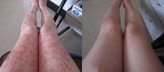 长春治疗牛皮癣
