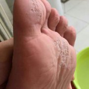 手足癣治疗