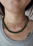 长春治疗白癜风医院