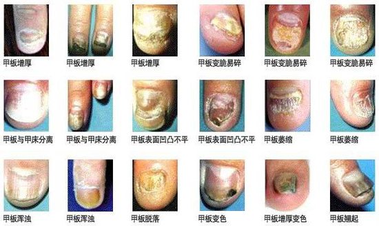 灰指甲一些表现症状