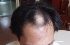 斑秃脱发治疗