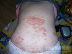 牛皮癣治疗症状表现