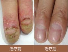 灰指甲治疗前后图对比