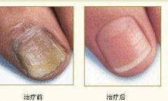 灰指甲治疗前后对比