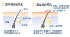 青春痘病因图
