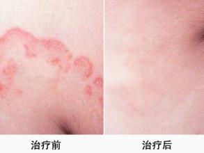 长春医院皮肤科治疗皮肤病