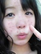脸上为什么长痘痘