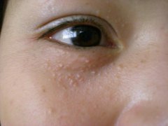 扁平疣的症状表现
