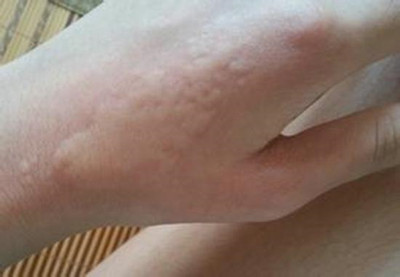 顽固性荨麻疹能治好吗