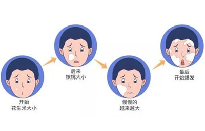 白癜风拖着不治会怎样?